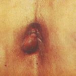 Геморрой у беременных лечение 13