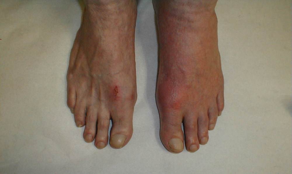 Types Of Toe Rashes At Kim Wilkinson Blog