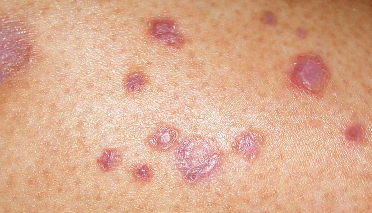 Diabetic skin rash images Symptoms and pictures