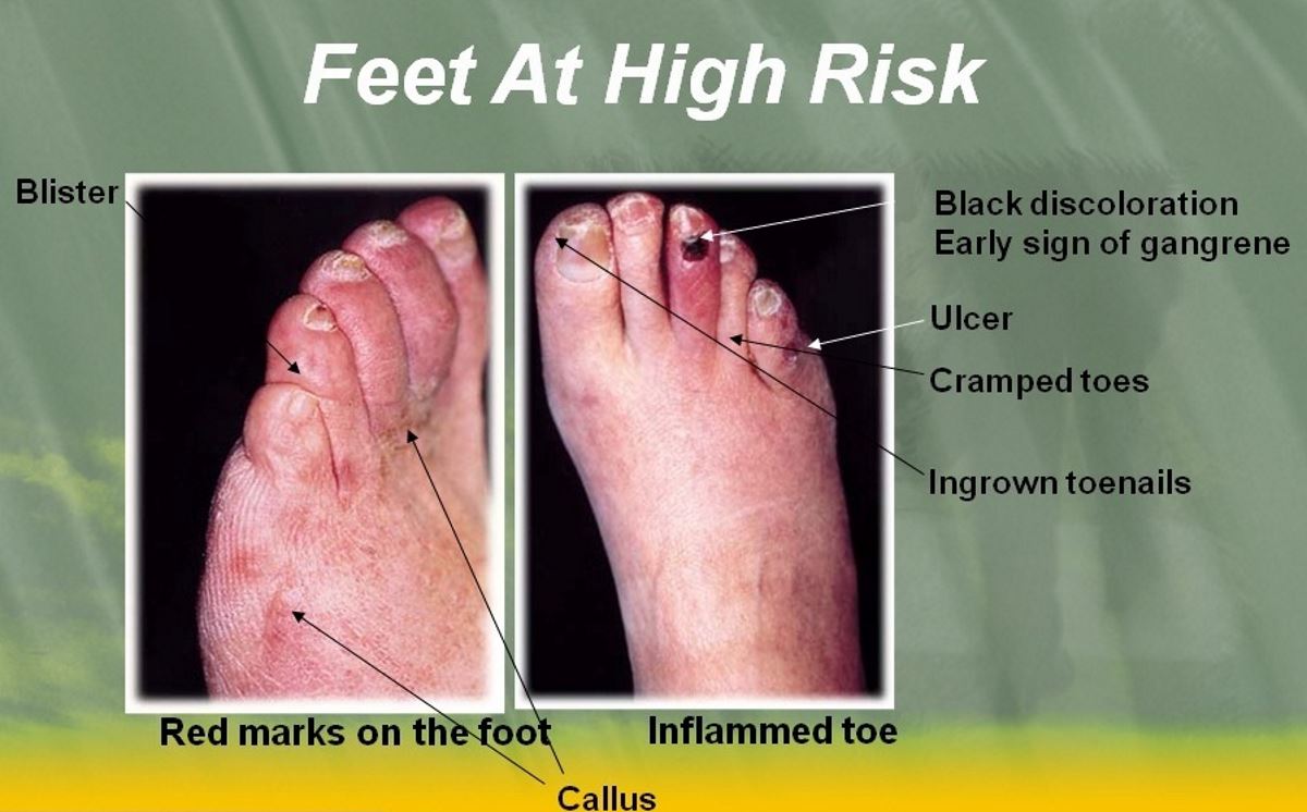 Diabetic Toes Pictures 1 Symptoms And Pictures