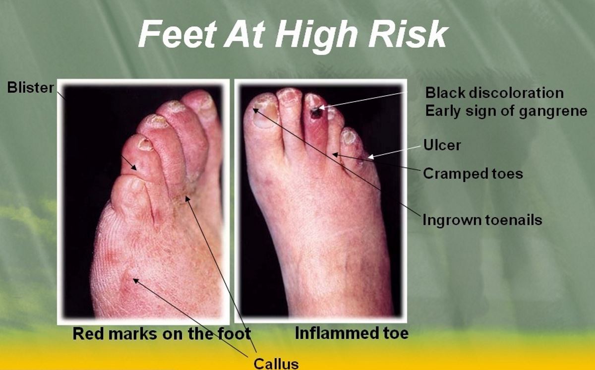 diabetic-toes-pictures-1-symptoms-and-pictures