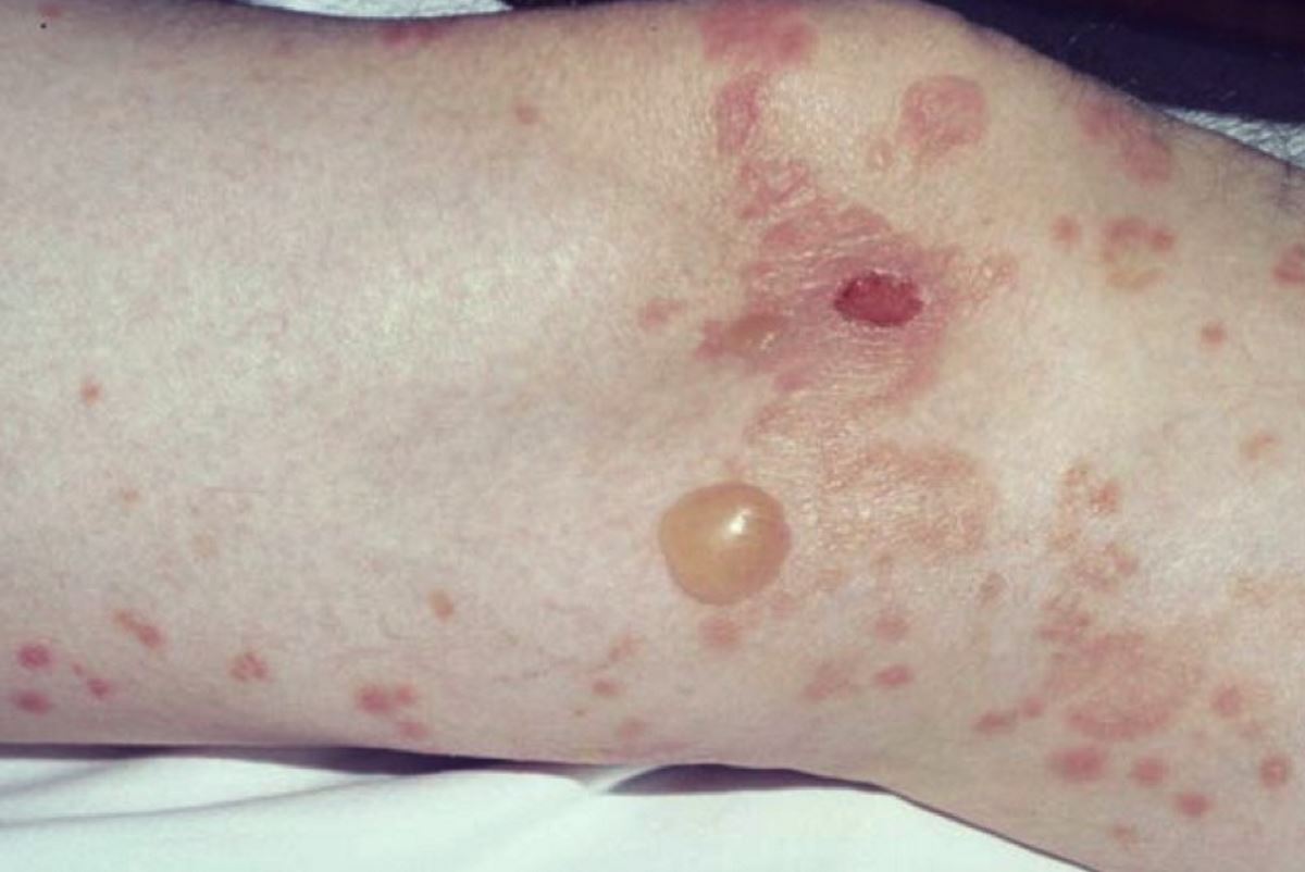 diabetic-blisters-on-feet-pictures-1-symptoms-and-pictures