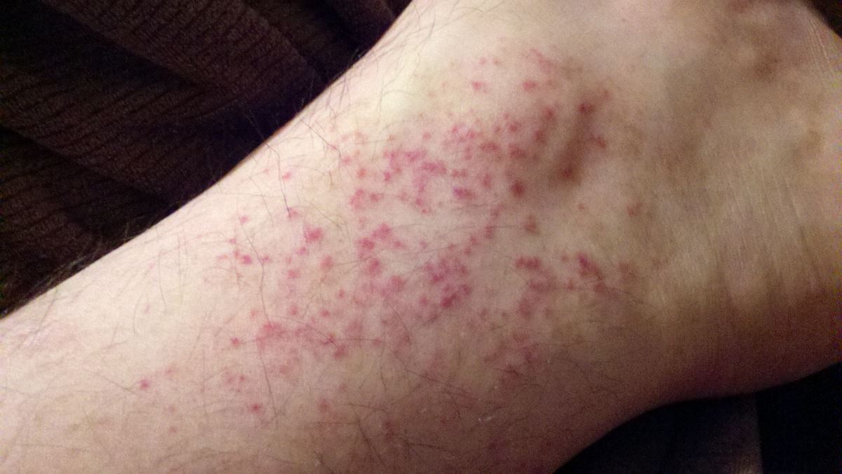 Diabetic Rash On Legs Pictures Symptoms And Pictures 3338