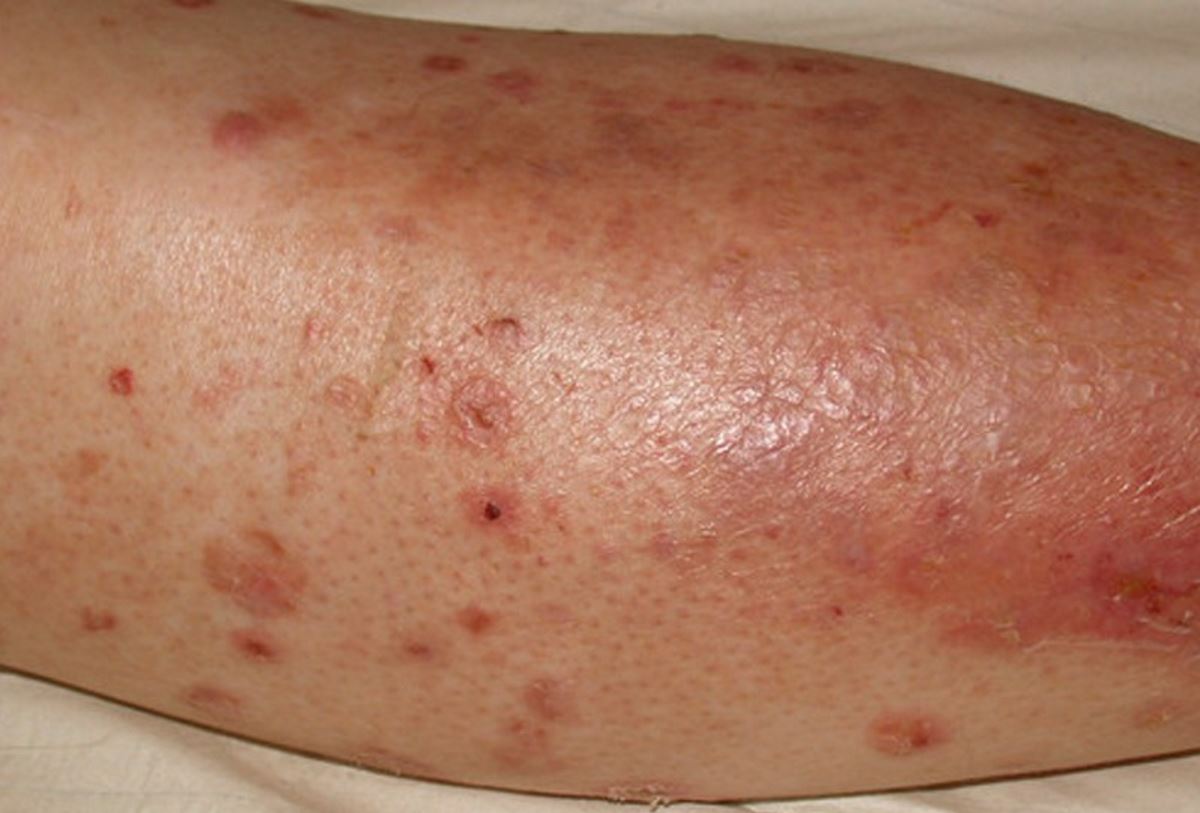 Diabetic Sores On Legs Images Symptoms And Pictures