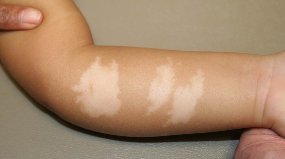 Vitiligo In Children Pictures Symptoms And Pictures