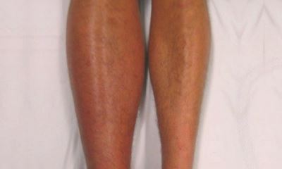 dvt leg symptoms thrombosis deep vein signs