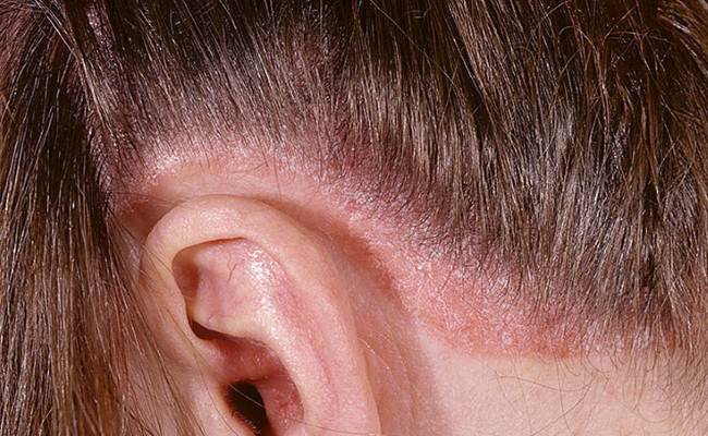 Does Scalp Psoriasis Lead To Baldness