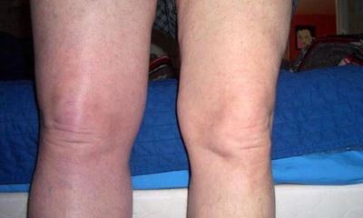 dvt leg signs thrombosis deep vein symptoms warning
