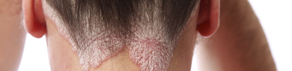 What does psoriasis look like