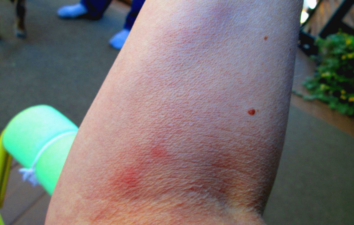 Blood Clot Symptoms In Arm Pictures Blue Lump On Forearm