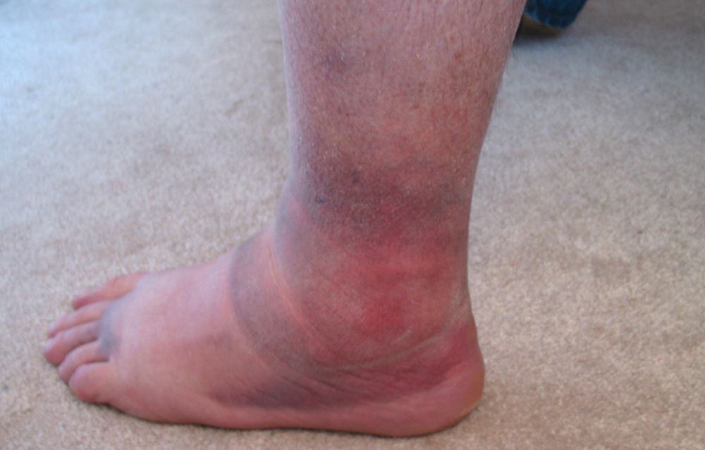 What Are Signs Of A Blood Clot In Your Foot At Tina Reinhardt Blog