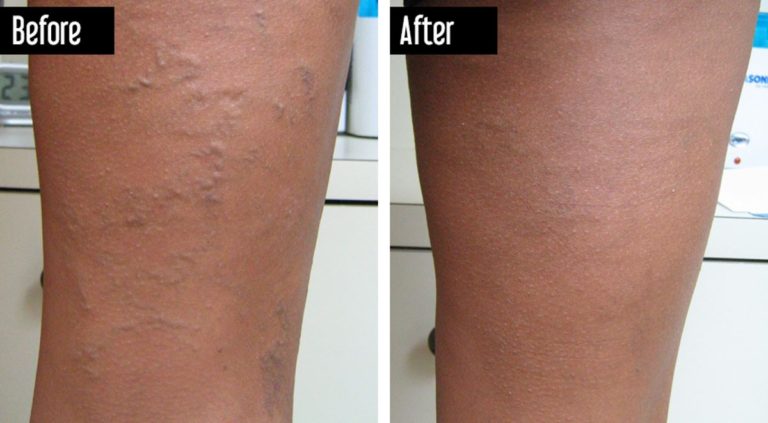 Varicose Veins Before And After Pictures Symptoms And Pictures