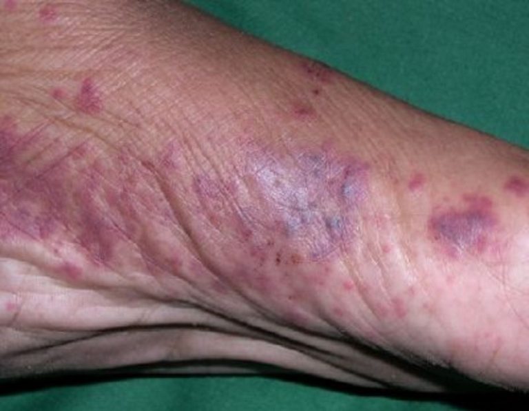 Rheumatoid Vasculitis Symptoms Pictures Symptoms And Pictures