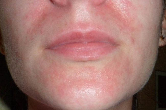 Perioral Dermatitis Pictures Radiation Dermatitis Pictures Seborrheic The Best Porn Website