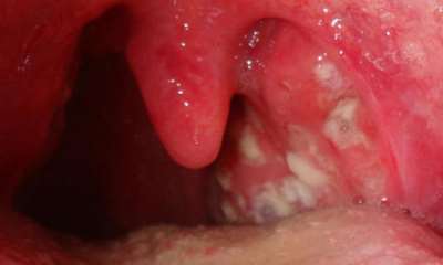 symptoms Deep throat