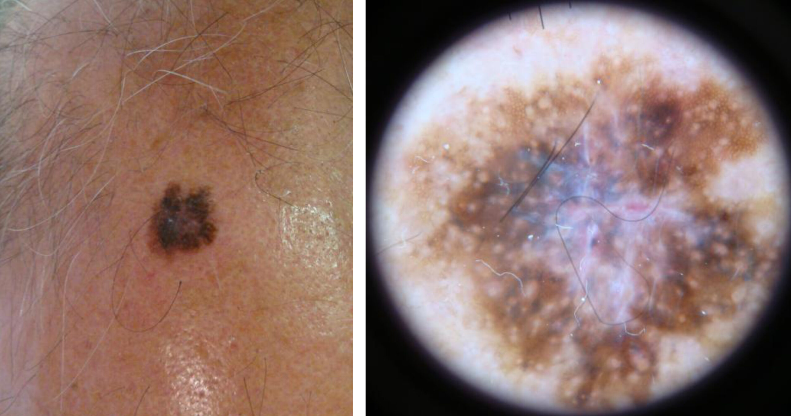 melanoma-on-scalp-pictures-early-stage-1-scalp-melanoma-images