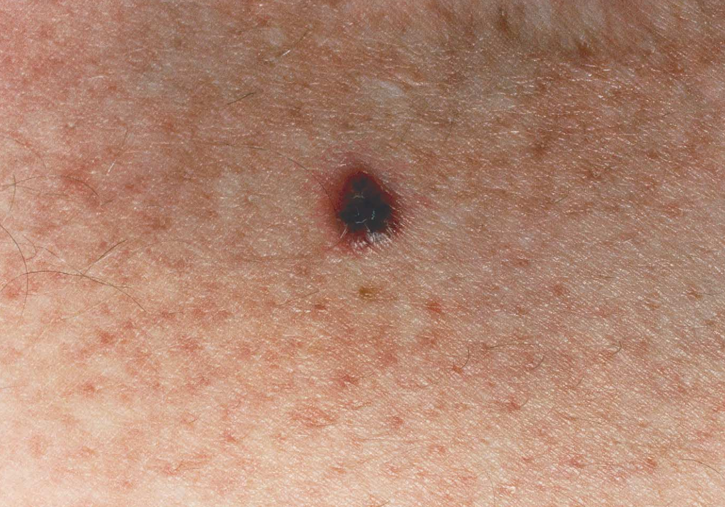 Skin Cancer Melanoma Treatment Causes Stages Early Si 1316