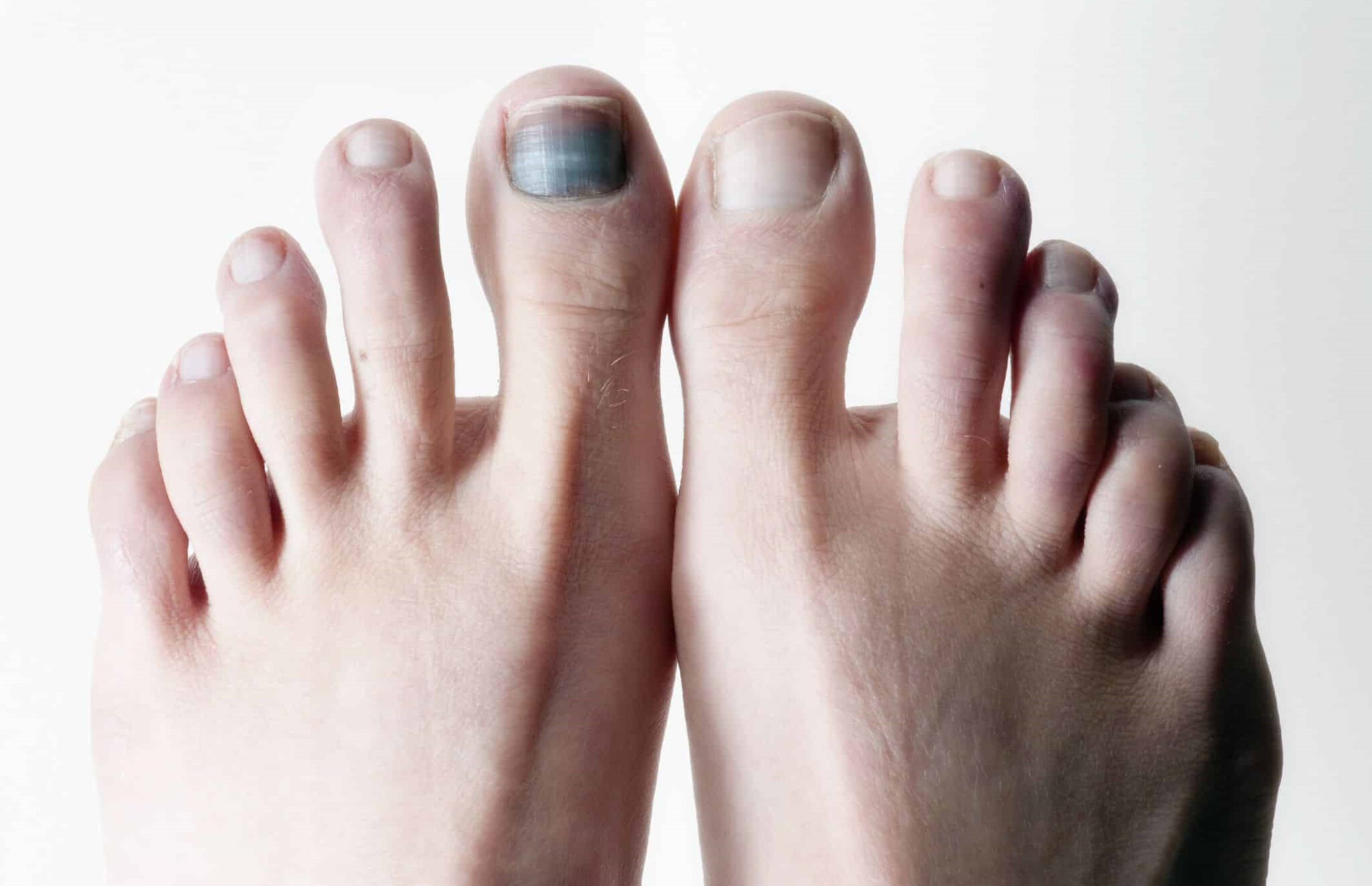 Melanoma In Nail Bed Picture Symptoms And Pictures The Best Porn Website