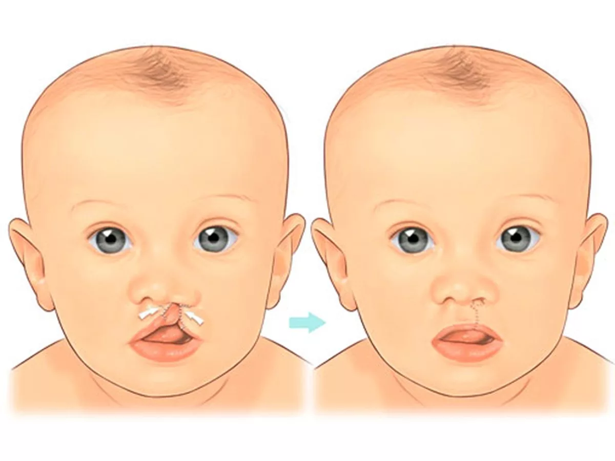Cleft Palate images