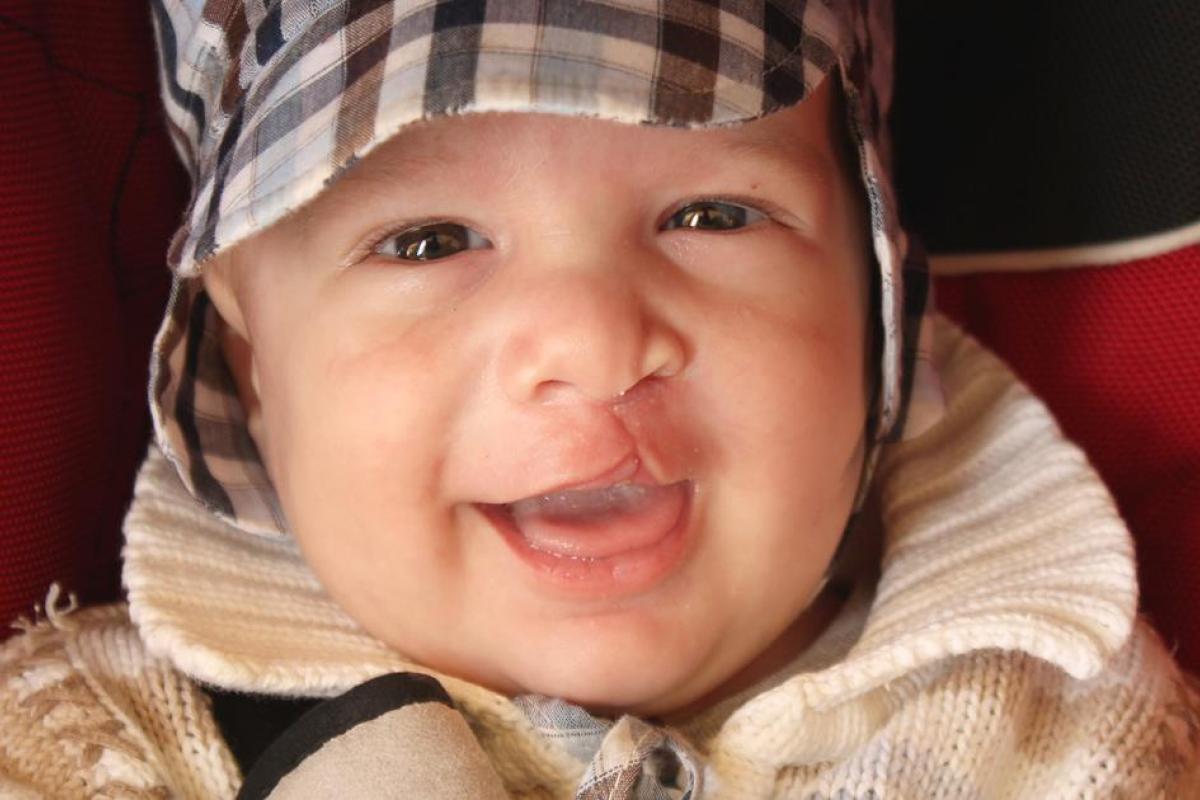 Cleft Palate photos