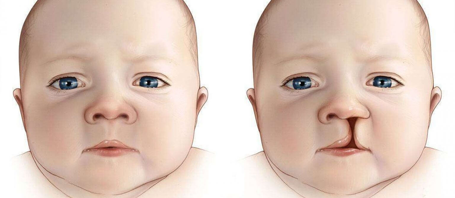 Cleft Palate pictures
