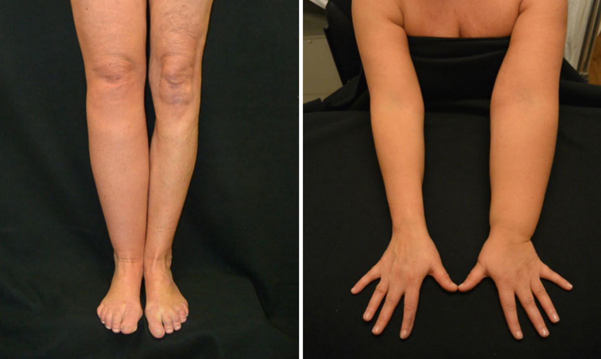 Early Signs of Lymphostasis pictures