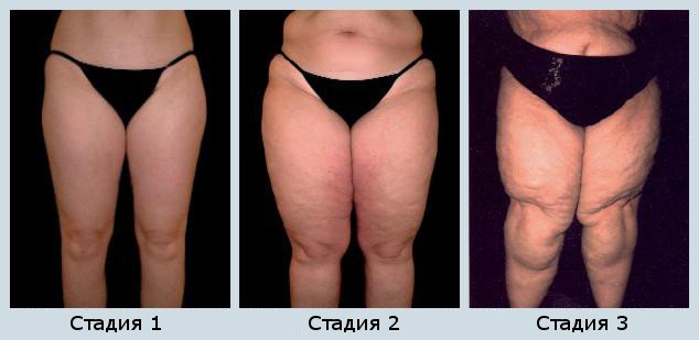 Lymphostasis images in Body