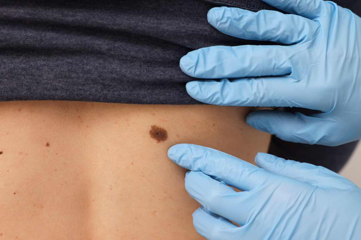Skin Cancer symptoms pictures