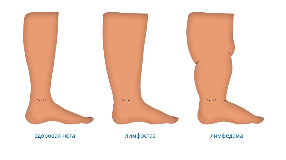 Stages of Lymphostasis photos