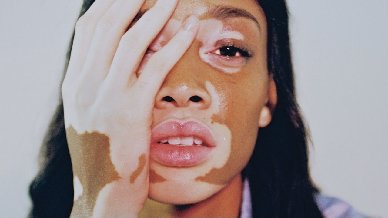 Vitiligo photos 2
