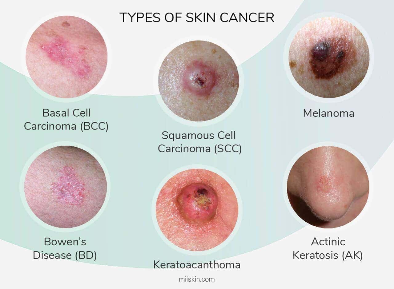 What does skin cancer look like
