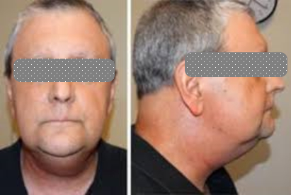 pictures of Lymphostasis