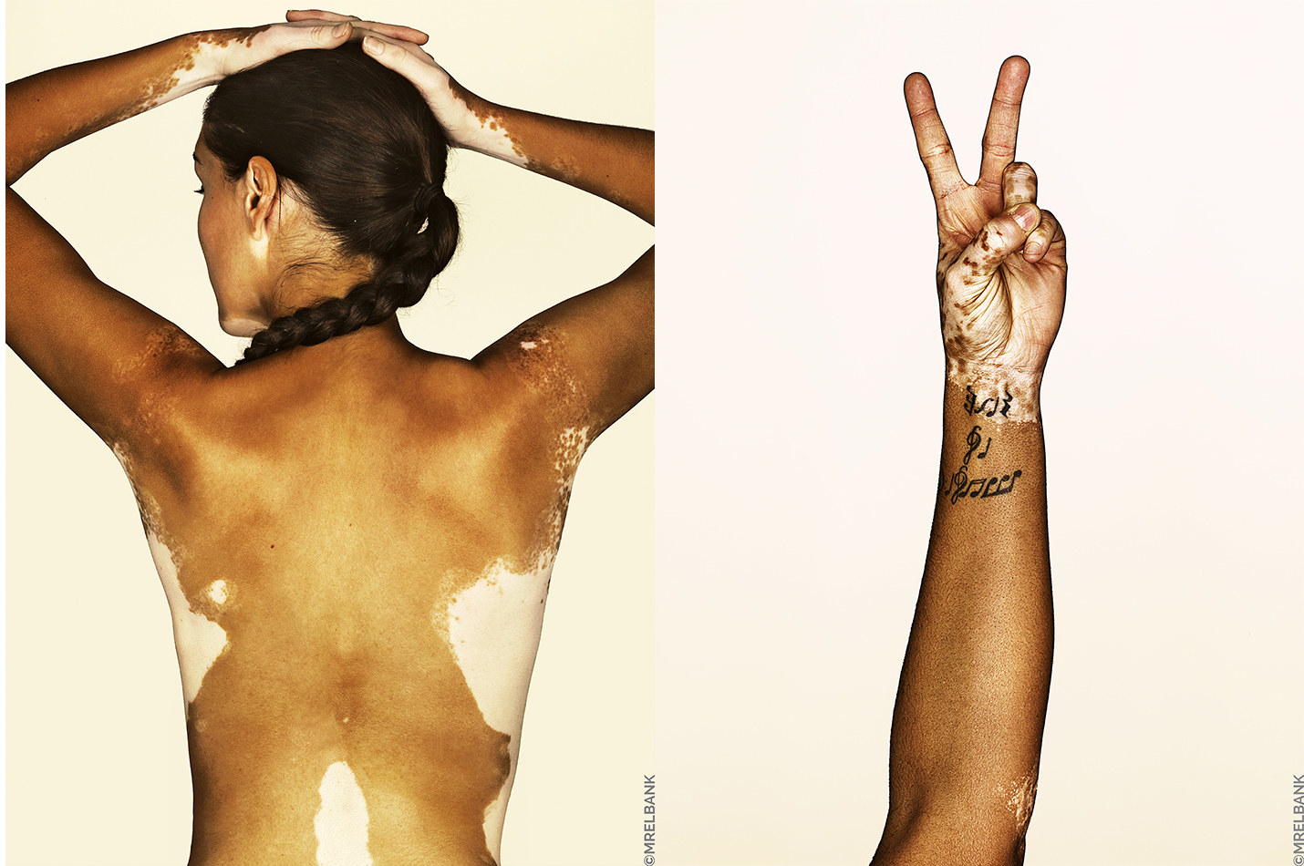 vitiligo images 3