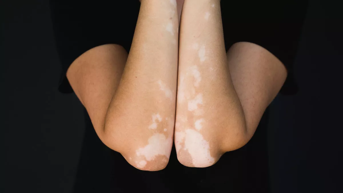vitiligo pics 4