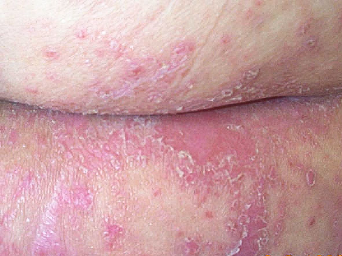 Diaper Rash Yeast infection Pictures