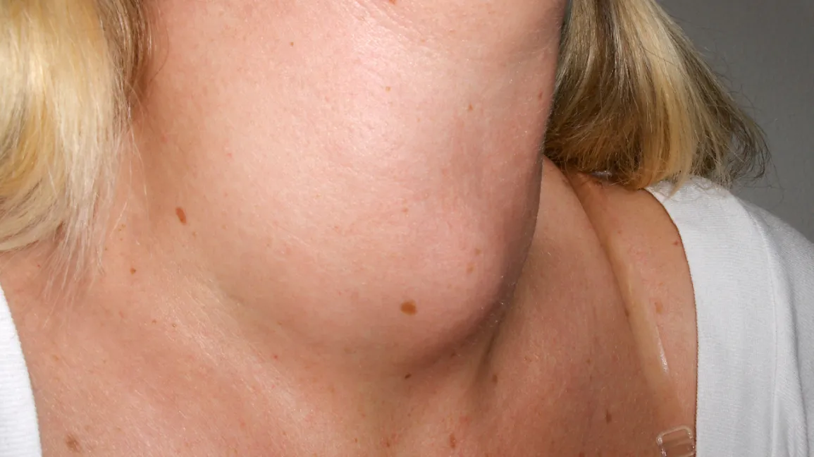 Goiter Symptoms Pictures
