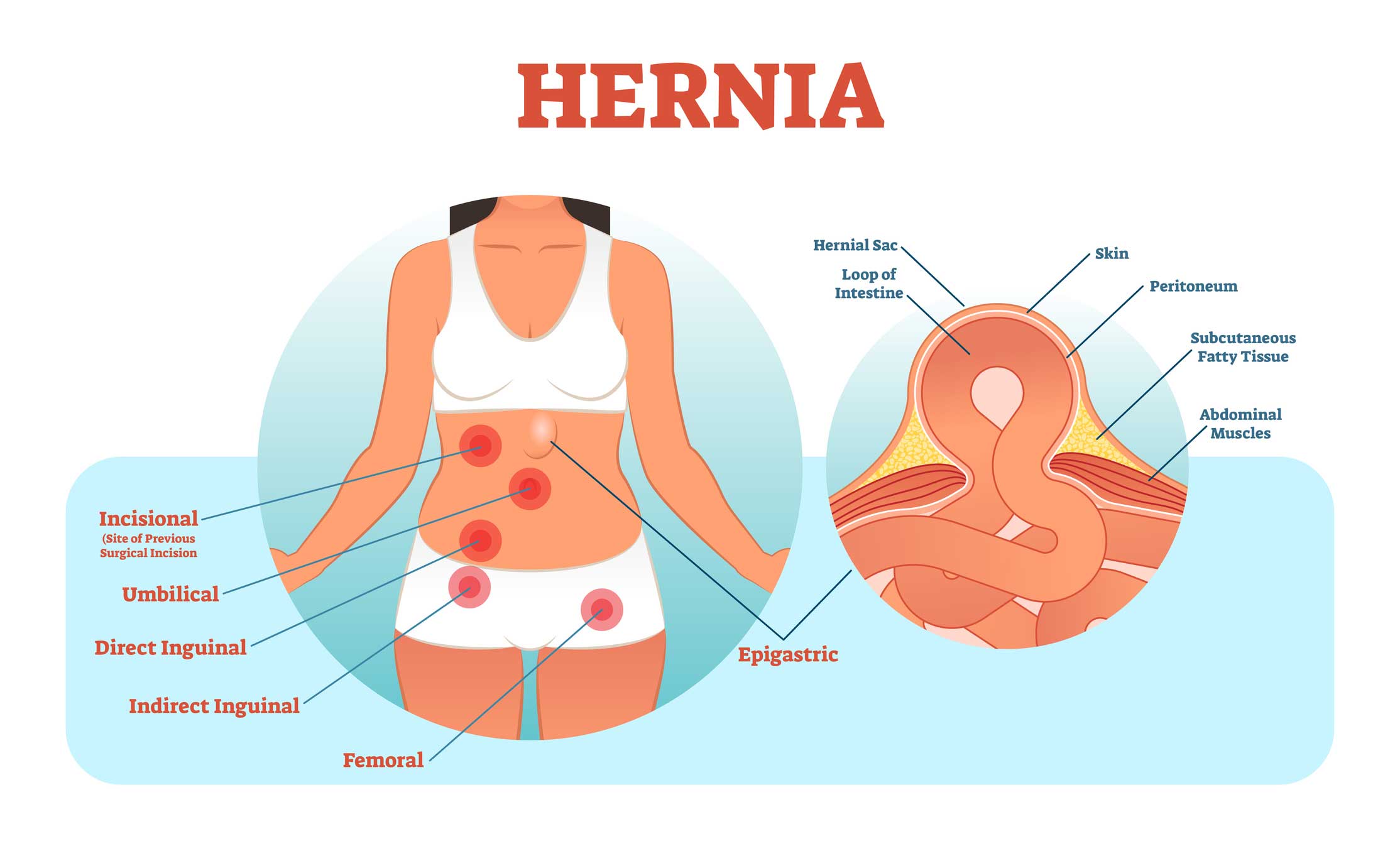 Hernia Symptoms Pictures