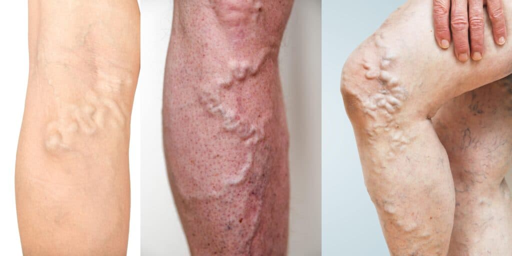 Signs of Deep vein thrombosis