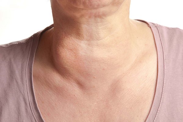 Thyroid swelling Symptoms Pictures