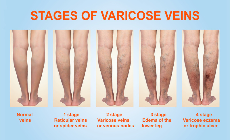Varicose veins Symptoms Pictures