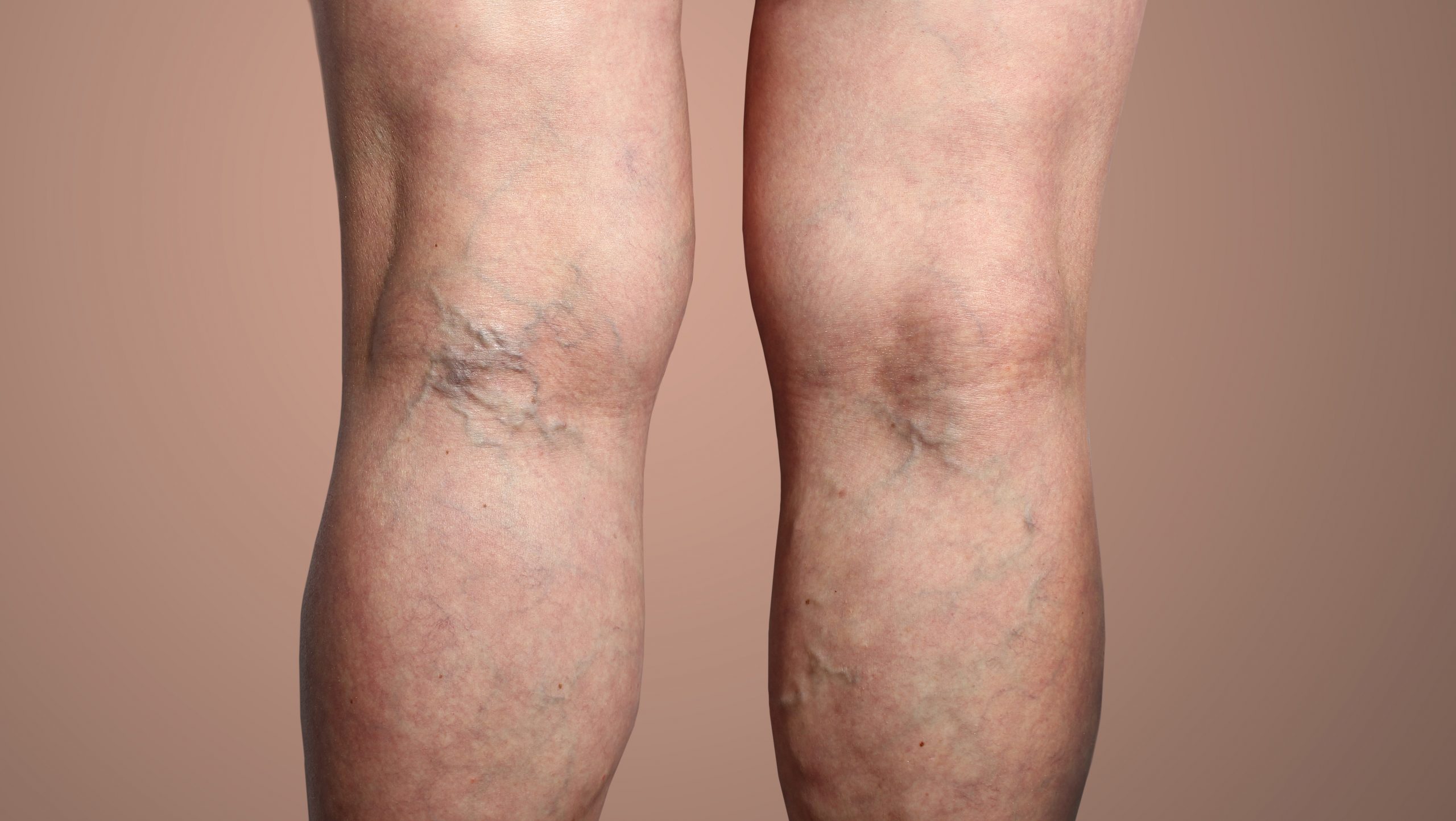 What Does Varicose Veins Look Like Symptoms Pictures