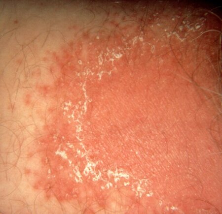 Yeast infection Symptoms Pictures