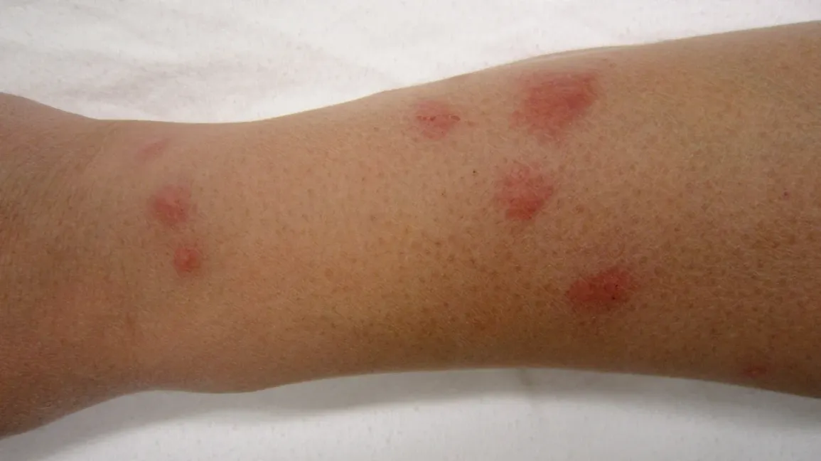 Bed bug bites Symptoms Pictures