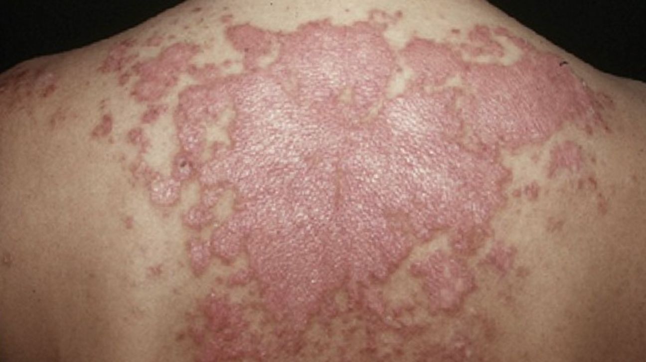 Lupus rash Symptoms Pictures