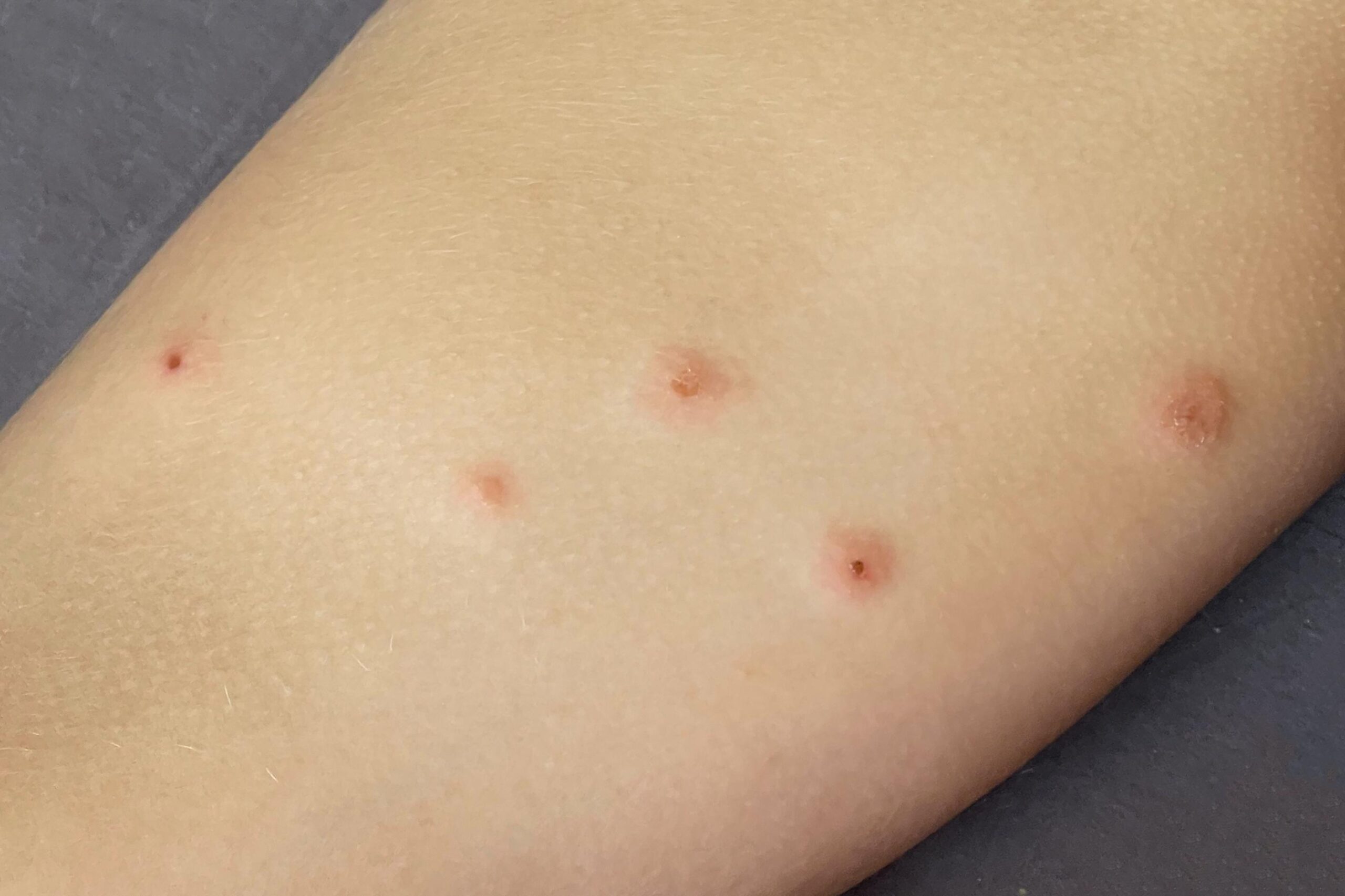 What Does Bed Bug Bites Look Like Pictures