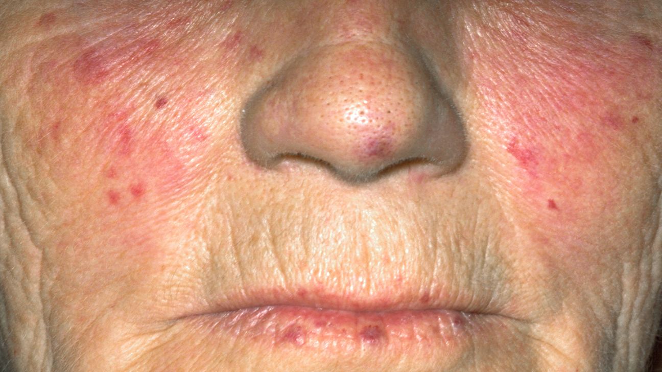What Does Lupus Rash Look Like Pictures