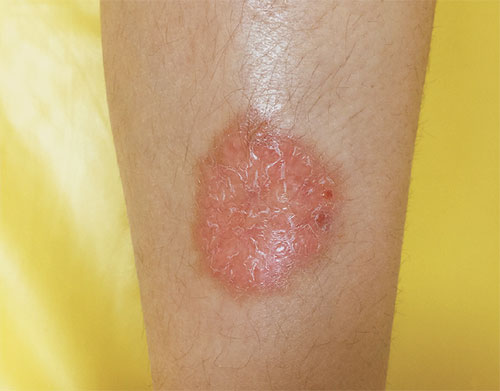 What does Necrobiosis Lipoidica look like