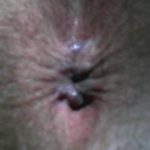 After hemorrhoid surgery pictures