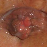 External hemorrhoids images