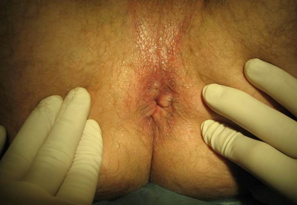 Hemorrhoid skin tag picture. 